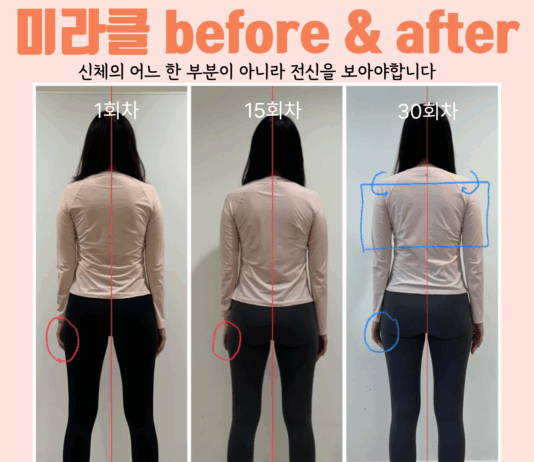 계속되는 어깨 뭉침, 과연 어깨의 문제일까요?