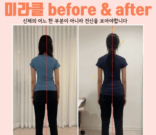 선천적인 척추측만,필라테스로 교정 가능할까?